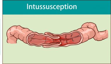 bağırsak İnvajinasyon vektör Illustration. tıkanıklığı