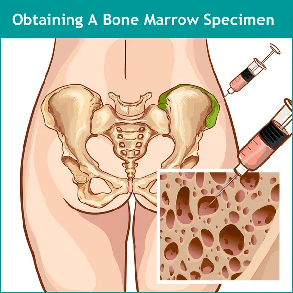 VECTOR DE UMA ASPIRAÇÃO DE MARROW ÓSSEO —  Vetores de Stock