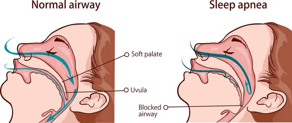 Vettore Illustrazione Una Sintroma Apnea Dormire — Vettoriale Stock