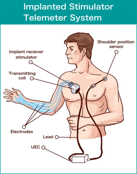 Sistema de telemetria do estimulador implantado — Vetor de Stock