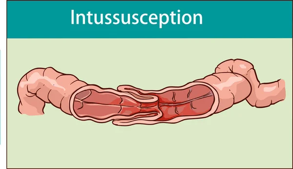 Ilustração vetorial da intussuscepção do intestino. obstrução — Vetor de Stock