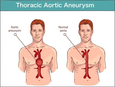Abdominal aort anevrizması türleri. normal aort ile genişlemiş ve