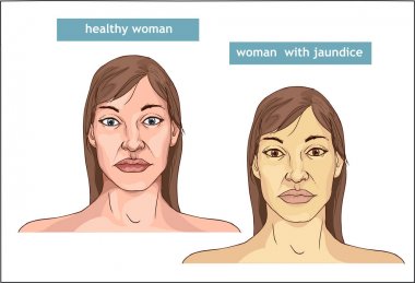 Normal cilt insanlar ve Jau sararma arasında karşılaştırma