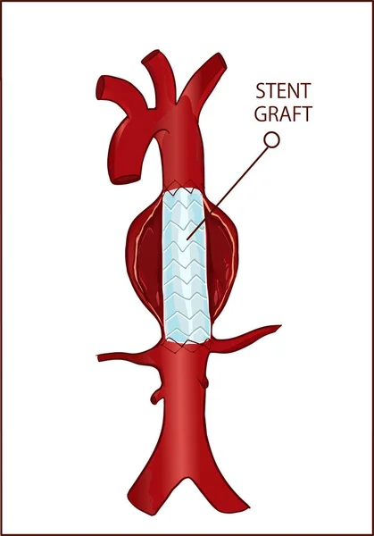 Aneurisma Aórtico Torácico Descendente Cirugía Endovascular — Vector de stock