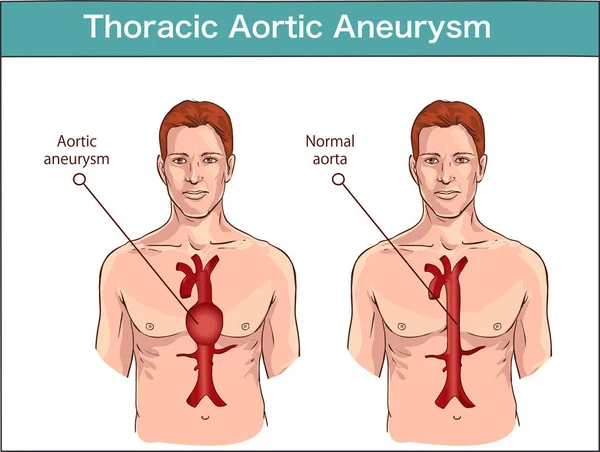 Tipos de aneurisma aórtico abdominal. aorta normal y aorta ampliada — Vector de stock