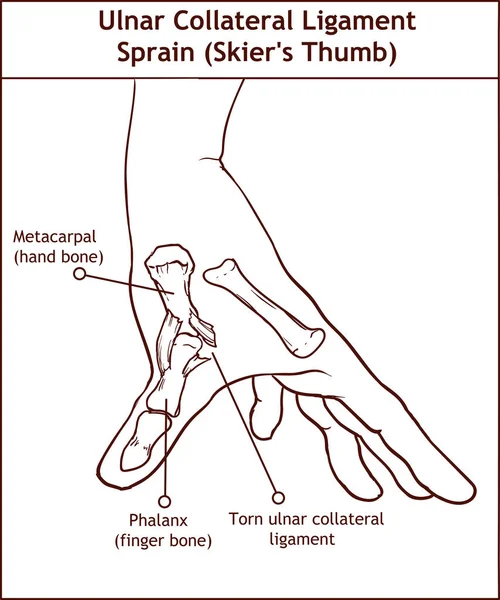 Ulnar Collateral Ligament Sprain (Skier's Thumb) — Stock Vector