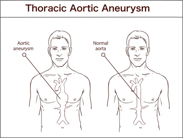 Tipos de aneurisma aórtico abdominal. aorta normal y aorta ampliada — Vector de stock