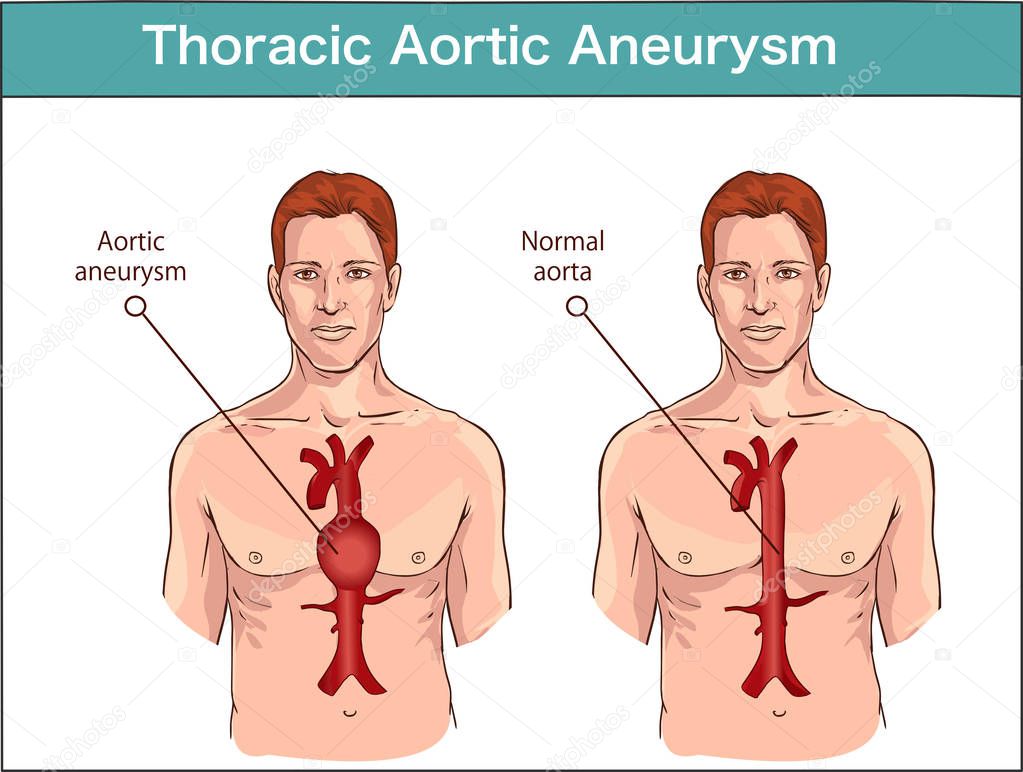 Types of abdominal aortic aneurysm. normal aorta and enlarged ve
