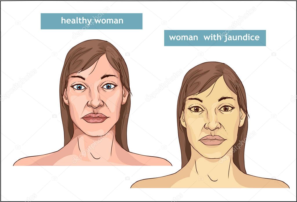 The Comparison between normal skin people and yellowing from Jau