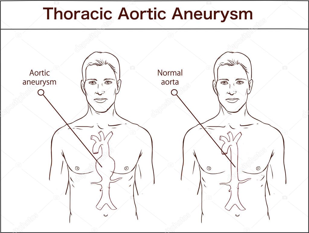 Types of abdominal aortic aneurysm. normal aorta and enlarged ve