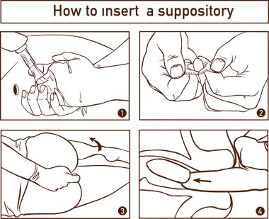 Drawing to show the location and technique of suppository insertion for the delivery of drugs per rectum clipart