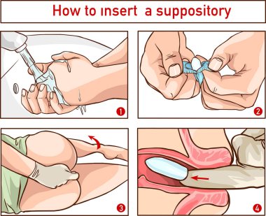 Drawing to show the location and technique of suppository insertion for the delivery of drugs per rectum clipart