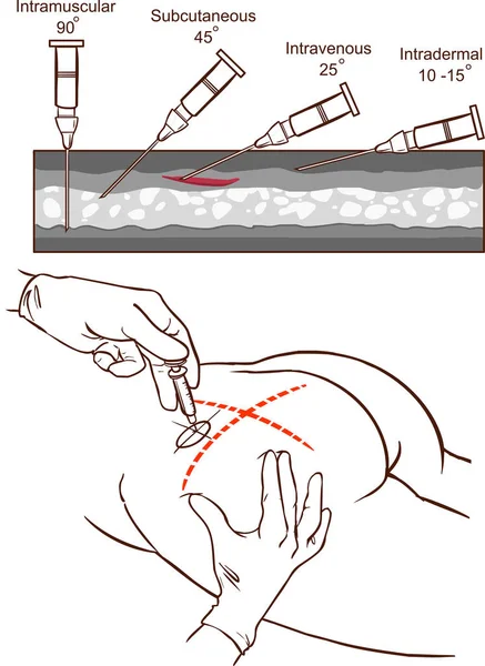 Intramusculaire Injectie Vector Illustratie Vergelijking Van Hoeken Van Intramusculaire Injectie — Stockvector