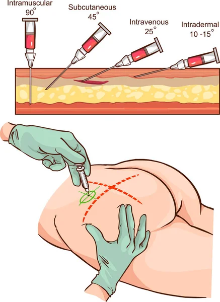 Intramusculaire injectie vector illustratie en vergelijking van de hoeken van intramusculaire injectie. — Stockvector