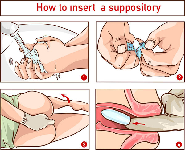 Drawing to show the location and technique of suppository insertion for the delivery of drugs per rectum