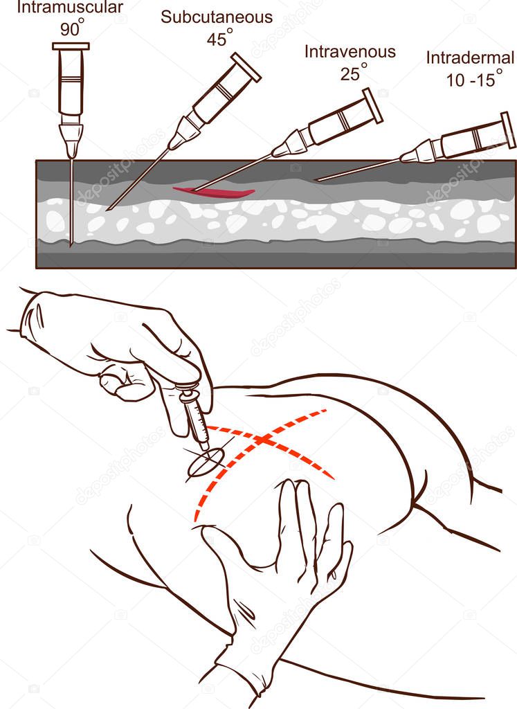 Intramuscular injection vector illustration and   Comparison of the angles of intramuscular injection.
