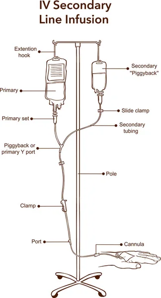 IV Linea secondaria Illustrazione vettoriale dell'infusione — Vettoriale Stock