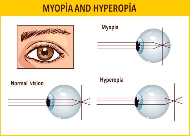 Optik insan gözü kusurları. Miyop ve hiperopya. Anatomik stru