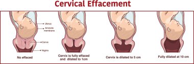 Vector - Cervical effacement and dilatation during labor clipart
