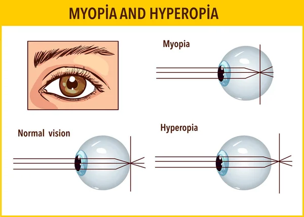 Optik insan gözü kusurları. Miyop ve hiperopya. Anatomik stru — Stok Vektör