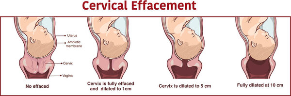 Vector - Cervical effacement and dilatation during labor