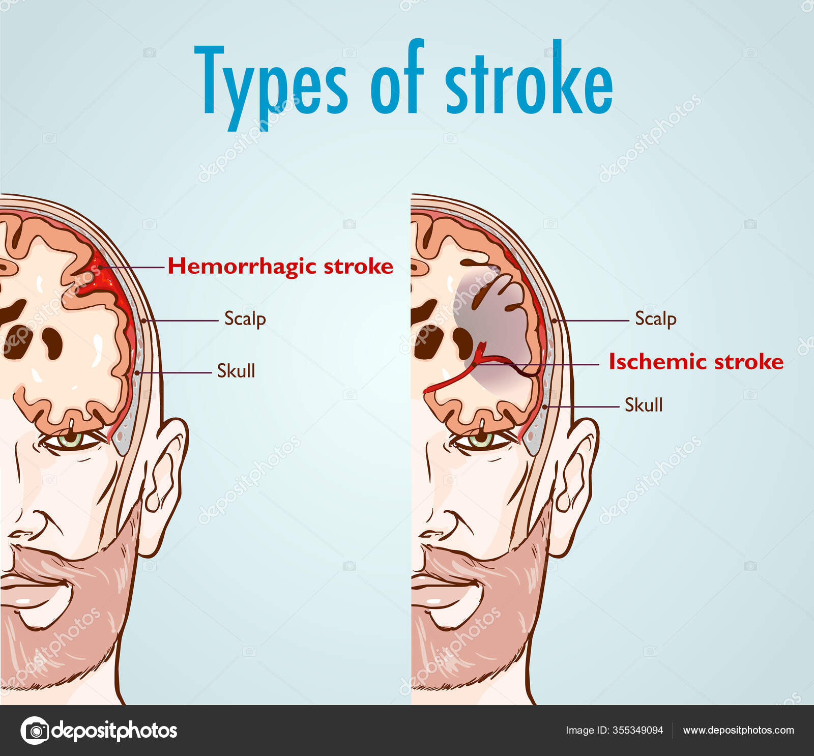 Hemorrhagic Ischemic Stroke Stock Vector Image By C Corbacserdar Gmail Com 355349094