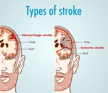 Hemorrhagic and ischemic stroke. clipart