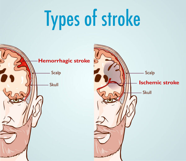 Hemorrhagic and ischemic stroke.