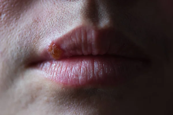 Close Infecção Pelo Vírus Herpes Boca Mulher — Fotografia de Stock