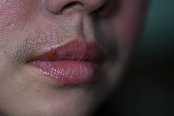 Close Infecção Pelo Vírus Herpes Boca Mulher Fotos De Bancos De Imagens
