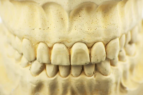 歯科補綴物の歯の型 — ストック写真