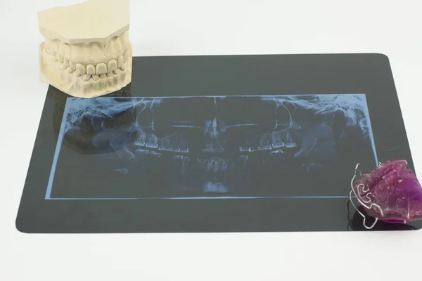 Radiología Dental Cavidad Mandibular Prótesis Monobloque Imagen De Stock