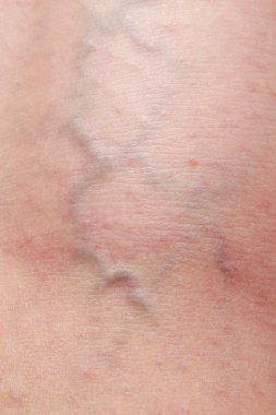 ayak üzerinde phlebeurysm