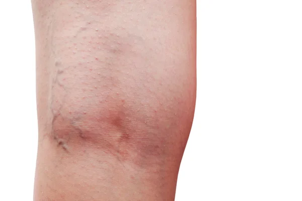 The phlebeurysm on legs — Stock Photo, Image