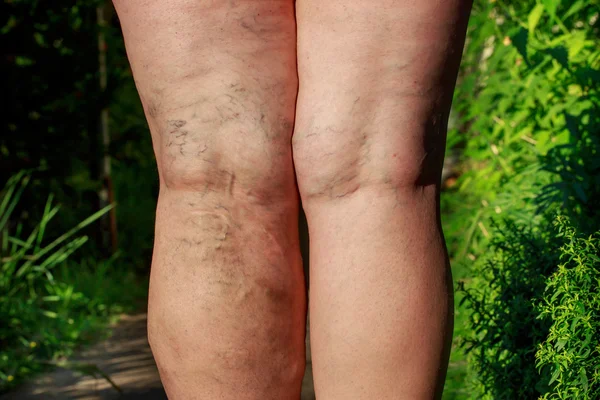 The phlebeurysm on legs — Stock Photo, Image