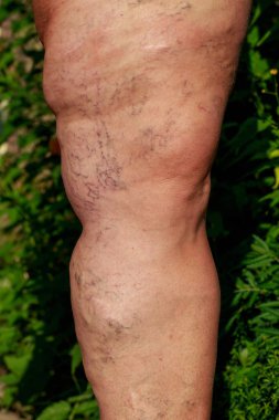 ayak üzerinde phlebeurysm