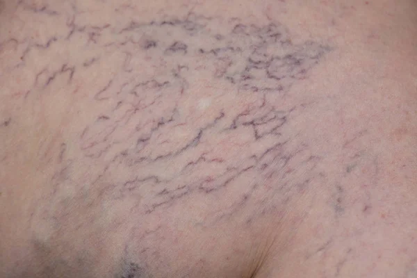 varisli bacakları üzerinde