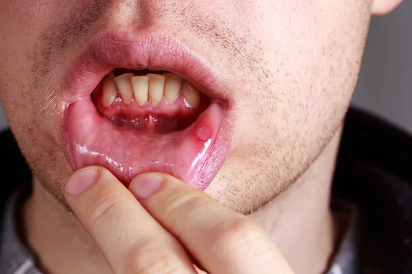 Stomatitis on the lips — Stock Photo, Image