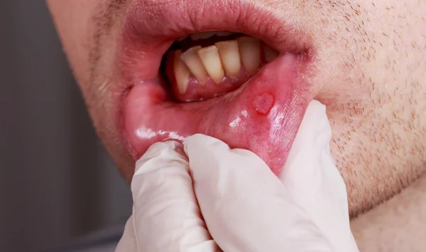 Stomatitis auf den Lippen — Stockfoto