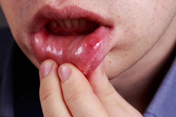 Estomatite nos lábios — Fotografia de Stock