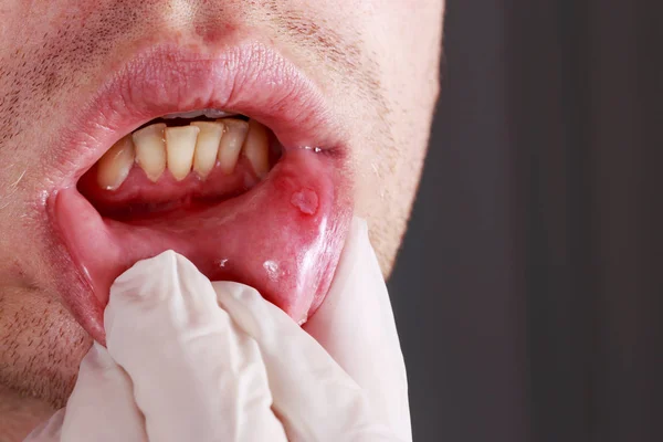 Stomatitis on the lips — Stock Photo, Image