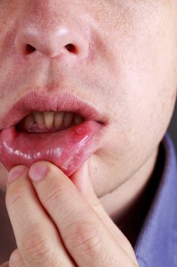Stomatitis on the lips clipart