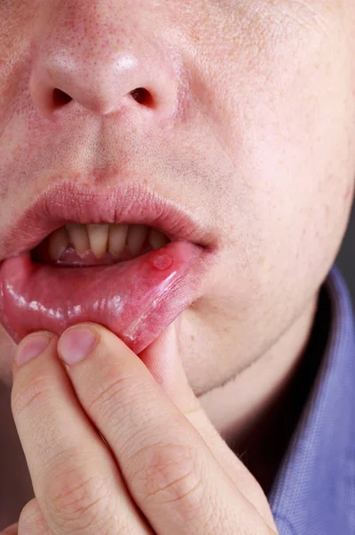 Stomatitis on the lips — Stock Photo, Image