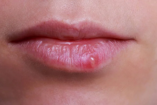 Herpes auf den Lippen — Stockfoto