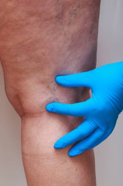 The disease varicose veins on a legs clipart