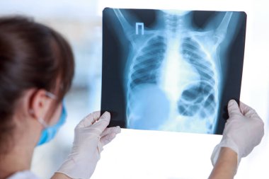 Doktor bir akciğerin röntgenini inceliyor.