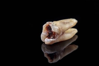 Uzak diş çürüğü siyah bir zemin üzerine tarafından zarar görmüş. Makro.