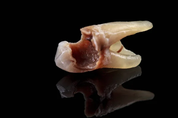 O dente remoto é danificado por cárie em um fundo preto. Macro . — Fotografia de Stock