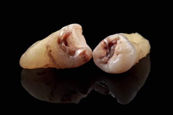Die durch Karies beschädigten entfernten Zähne auf schwarzem Hintergrund. Makro. — Stockfoto