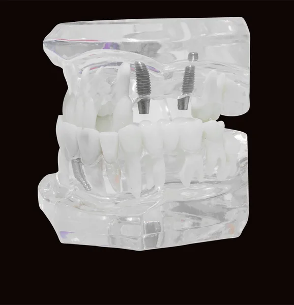 Стоматологічна модель пластику зубів прозорий на чорному тлі з відсічним контуром — стокове фото